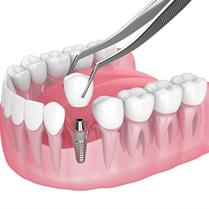 dental implants